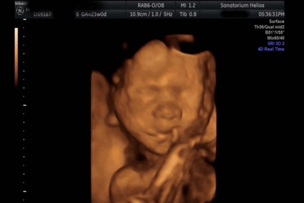 obrázek ze 3D ultrazvuku 4