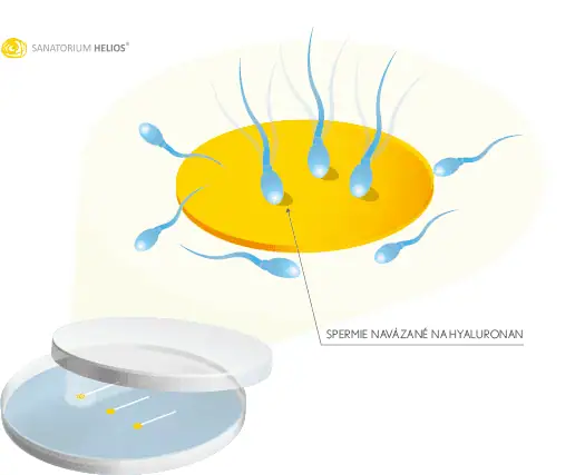 Volba metody oplození vajíček 3 - Sanatorium Helios CZ PICSI