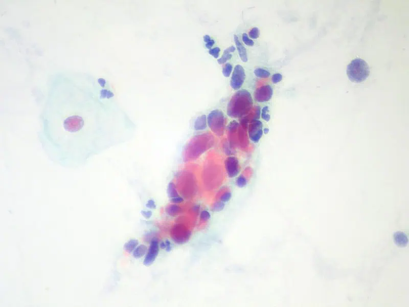 Onkologická cytologie 6 - Sanatorium Helios CZ Onkologická cytologie 5 - Sanatorium Helios CZ