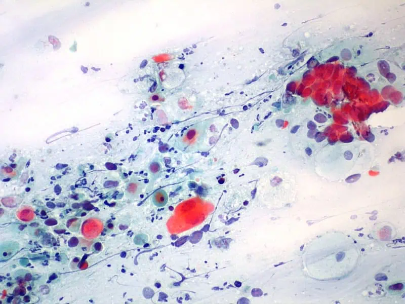 Onkologická cytologie 12 - Sanatorium Helios CZ Onkologická cytologie 11 - Sanatorium Helios CZ