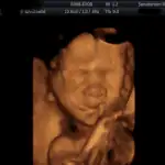 3D/4D ultrazvuk 4 - Sanatorium Helios CZ obrázek ze 3D ultrazvuku 4