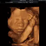 3D/4D ultrazvuk 3 - Sanatorium Helios CZ obrázek ze 3D ultrazvuku 3