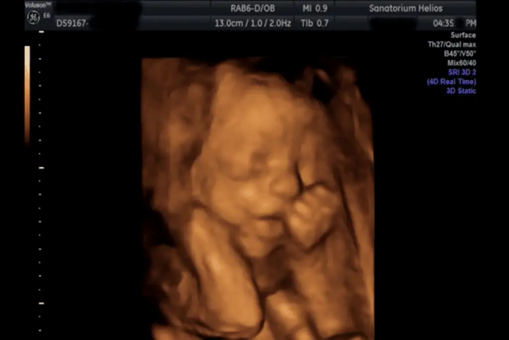 Ultrazvuková diagnostika 1 - Sanatorium Helios CZ obrázek ze 3D ultrazvuku 1