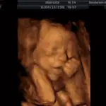 3D/4D ultrazvuk 1 - Sanatorium Helios CZ obrázek ze 3D ultrazvuku 1