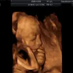 3D/4D ultrazvuk 2 - Sanatorium Helios CZ obrázek ze 3D ultrazvuku 2