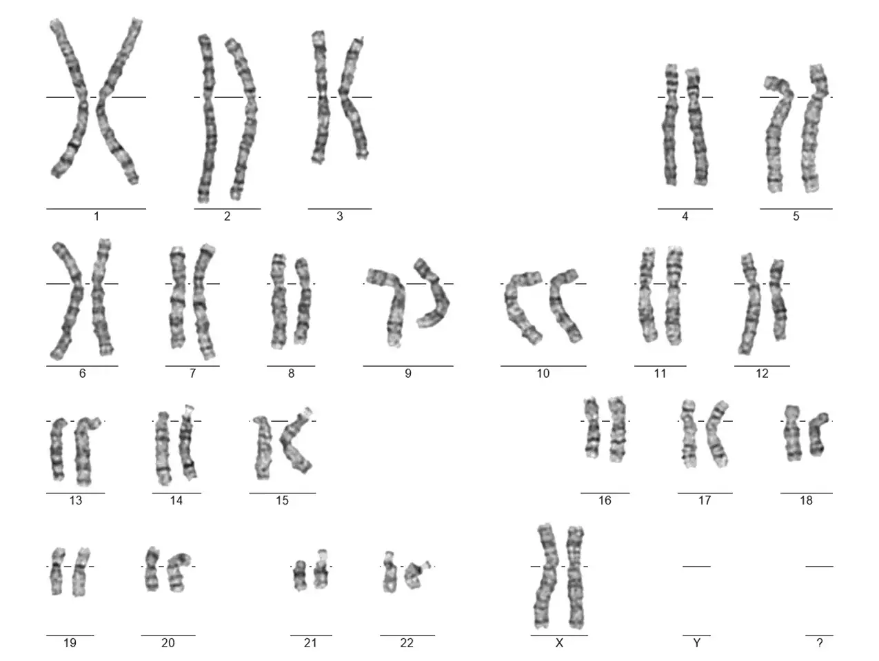 Cytogenetické vyšetření 2 - Sanatorium Helios CZ karyotyp ženy